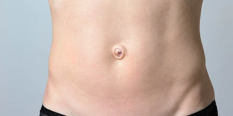 hernia umbilical