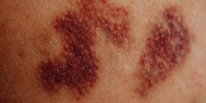 ¿Qué es un hematoma y qué tipos hay?