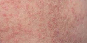 Roseola. Causas, síntomas y tratamiento