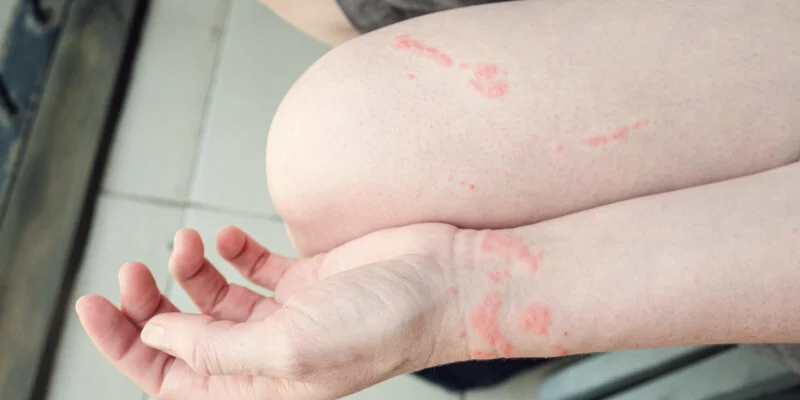 picadura de medusa en muñeca y muslo