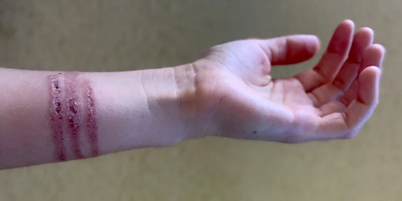 Picadura de medusa en antebrazo