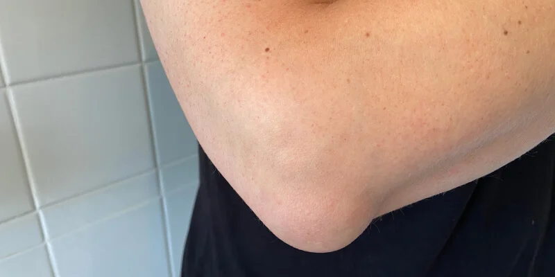 bursitis