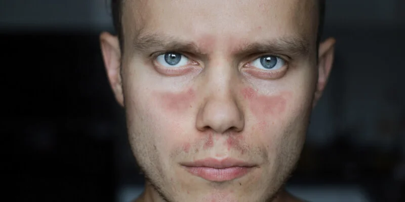 persona con síntomas de lupus en la cara