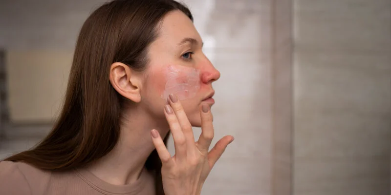 Mujer con rosácea vista de cerca