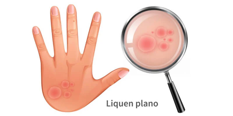 liquen plano visto con lupa