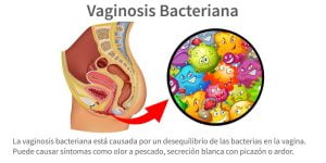 Qué es la vaginosis bacteriana
