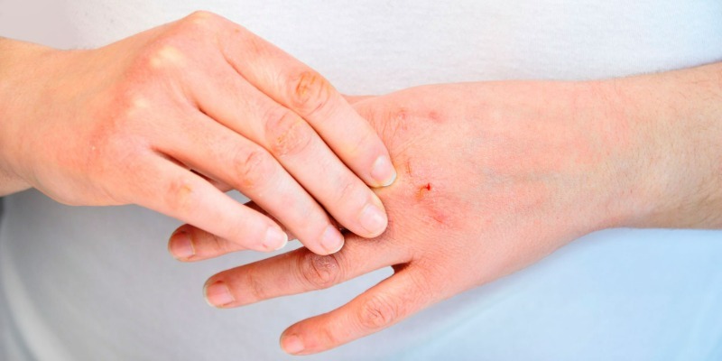 alergia al frío