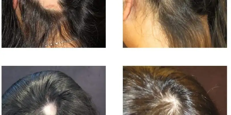 alopecia areata