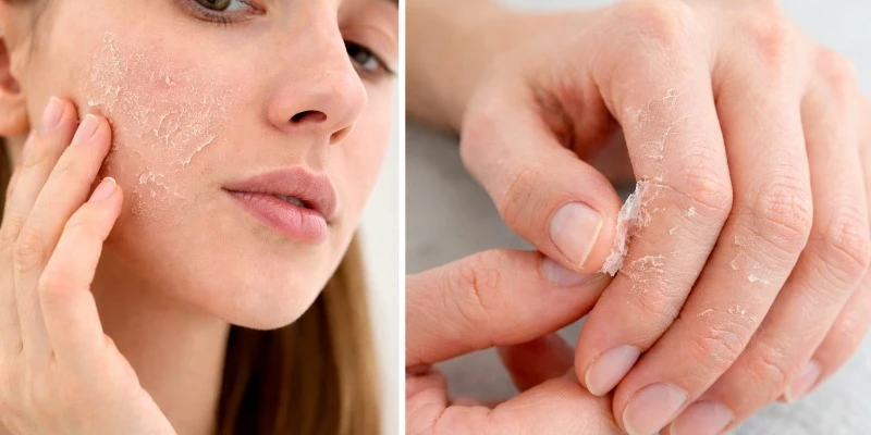 descamación de la piel