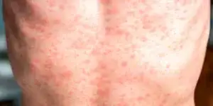 Sarampión: causas, síntomas, prevención y tratamiento